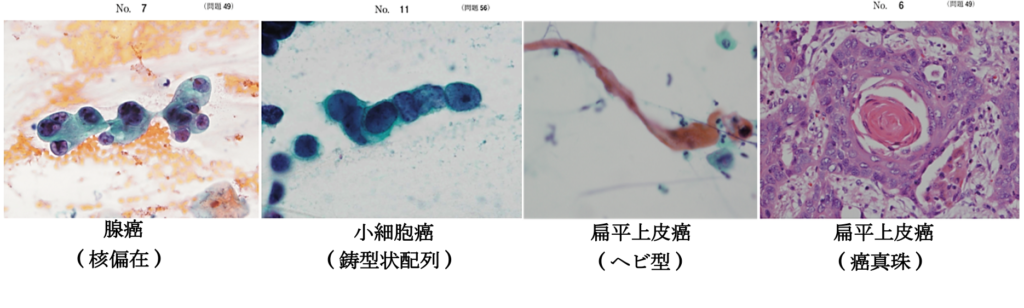腺癌・小細胞癌・扁平上皮癌の比較画像