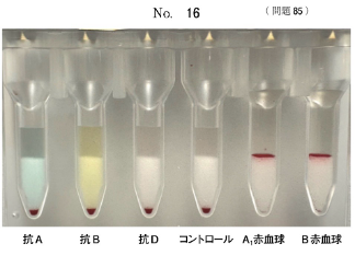 第72回問85の血液型検査のカラム凝集像